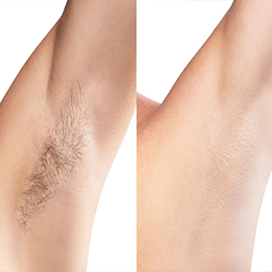 Book Laser Hair Removal in Gurgaon